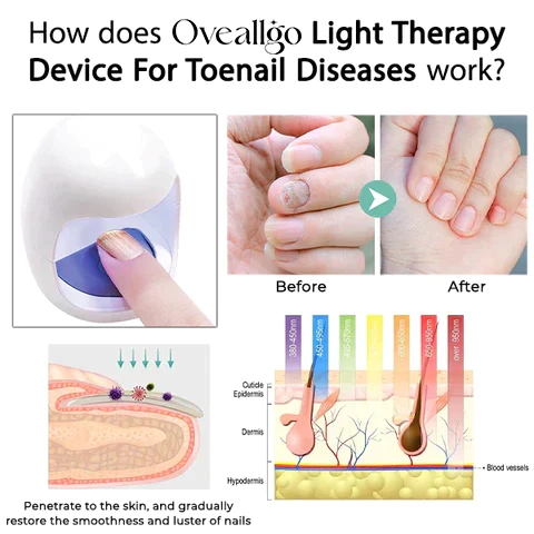 Oveallgo™ Light Therapy Device For Toenail Diseases - Image 4