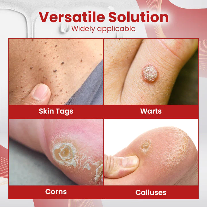 Ceoerty™ SkinClear Tags & Mole Remover - Image 7