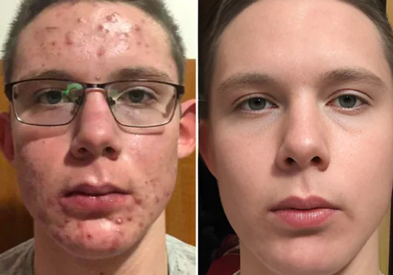 Biancat™ PoreClear 2% BHA Hauterneuerungsflüssigkeit - Image 6