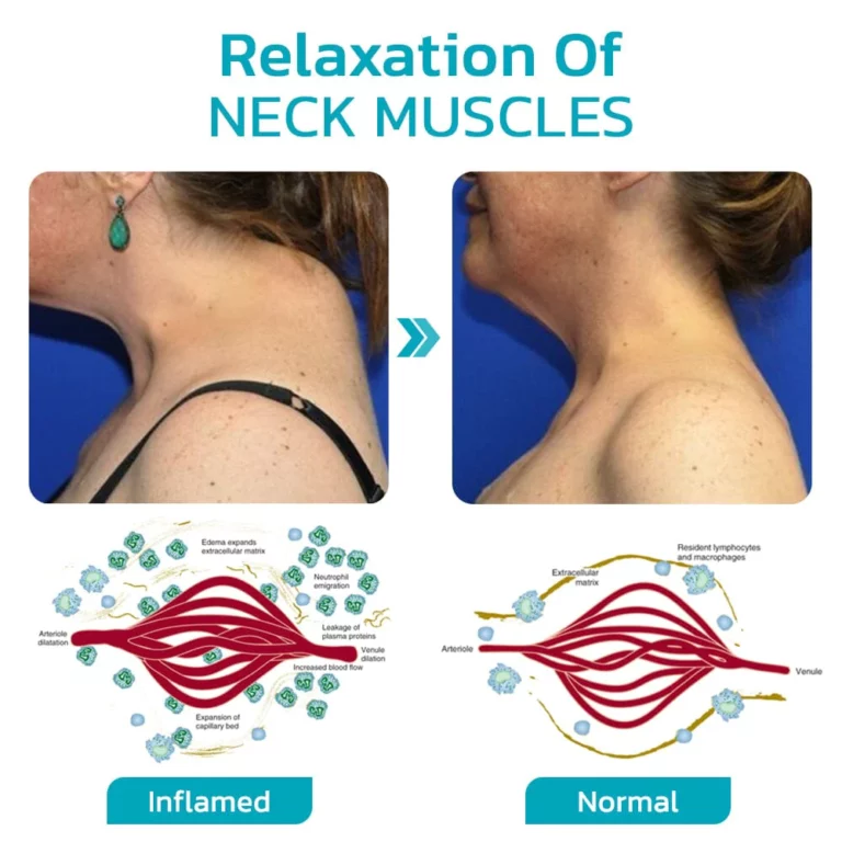 Furzero™ ChillNeck Ultrasonic Lymphatic Therapeutic Massager - Image 5