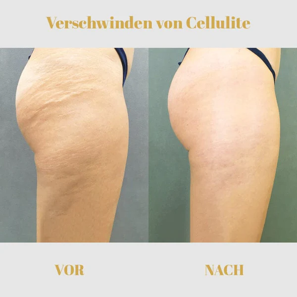 Ceoerty™ Hüftstraffendes Ätherisches Öl - Image 8