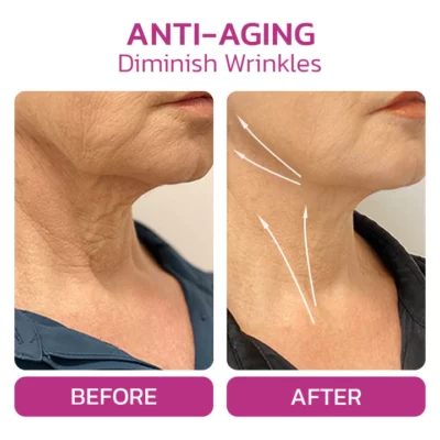 Furzero™ NECKUP Collagen Potentiating Neck Cream - Image 6