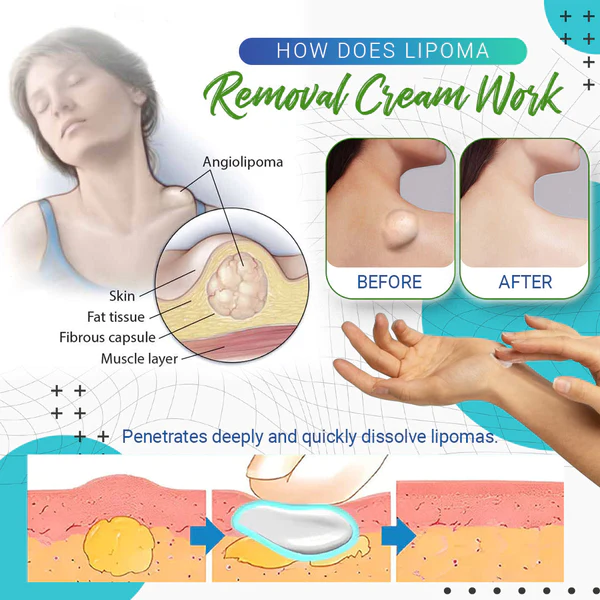 Dobshow™ Lipoma Removal Cream - Image 11