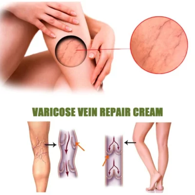 Awzlove™ Varicose Veins Spray - Image 6
