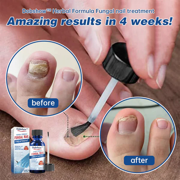 Dobshow™ Herbal Formula Fungal nail Paronychia treatment Gel - Image 9