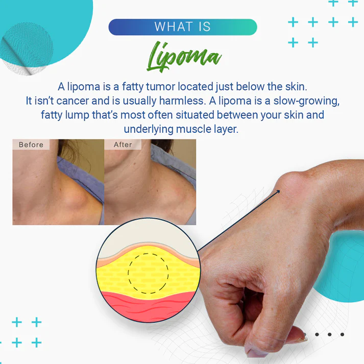 Cvreoz™Lipoma Removal Cream - Image 9
