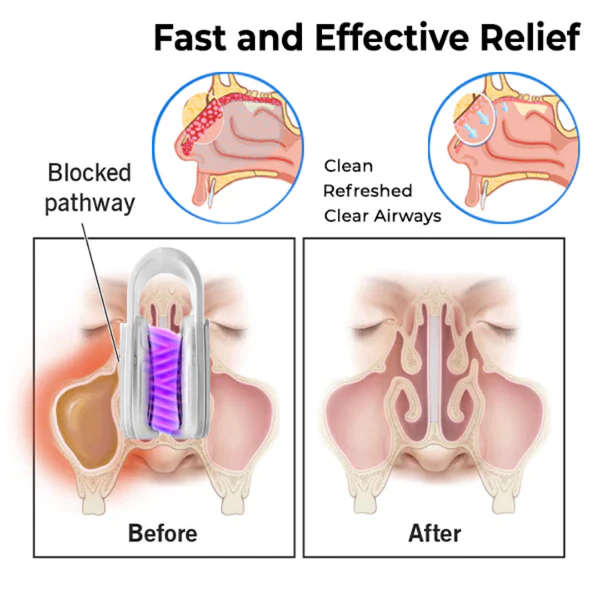Nasaflow™ Nasal Mucus Cleaning Device - Image 4