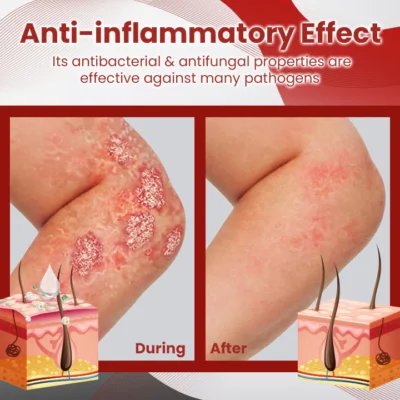 Ceoerty™ PsoriaCare Treatment Spray - Image 6