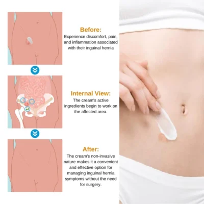 Oveallgo™ Inguinal Hernia Treatment Cream - Image 5