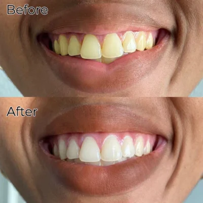 Fivfivgo™ Brilliance Soda Whitening Zahnpasta - Image 8