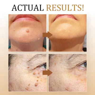 Primble™ Bee Venom Wart and Tags Removal Treatment Spray - Image 5