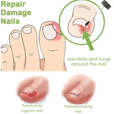 Biancat™ FungoClear Nail Paronychia Treatment Gel - Image 8