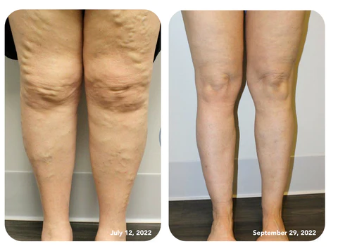 Furzero™ Bee Venom Lymphatic Drainage & Slimming Foot Soak Beads - Image 11