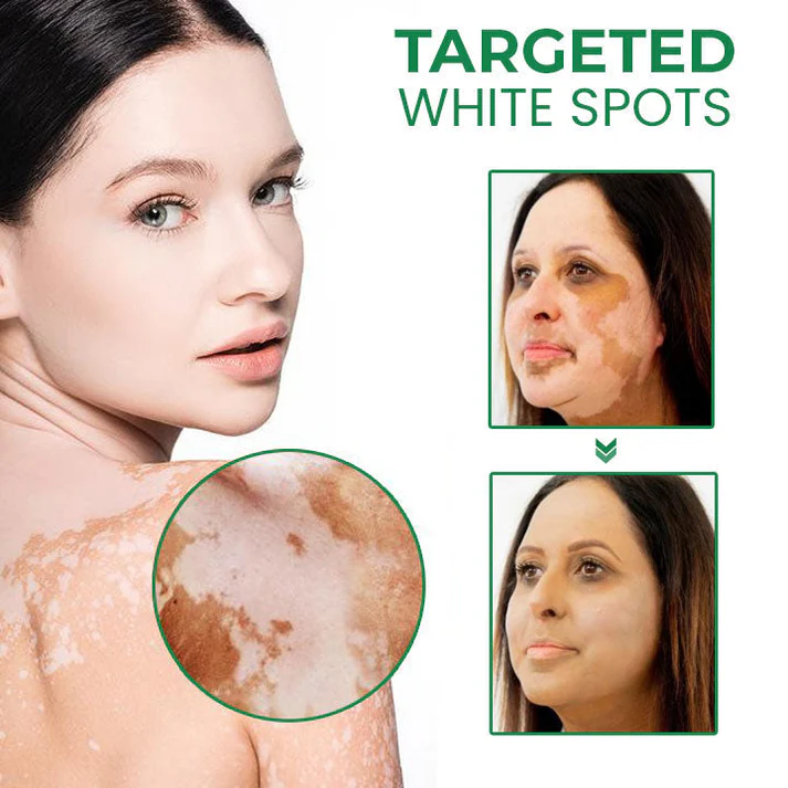 Lovilds™ VitiligoFix Revitalize Elixir - Image 12