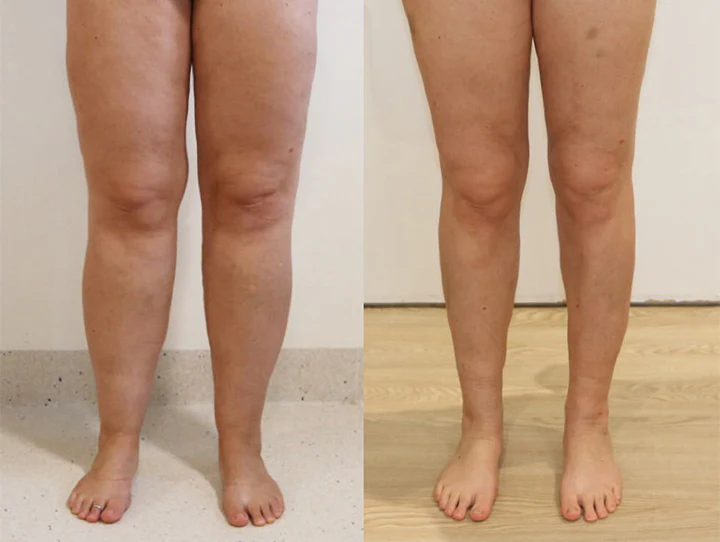 Ceoerty™ LymphaCare Bienengift-Einweichperlen - Image 8