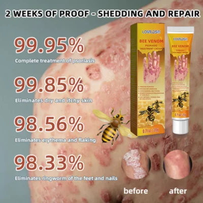 LOVILDS® Bee Venom Psoriasis Treatment Cream - Image 6