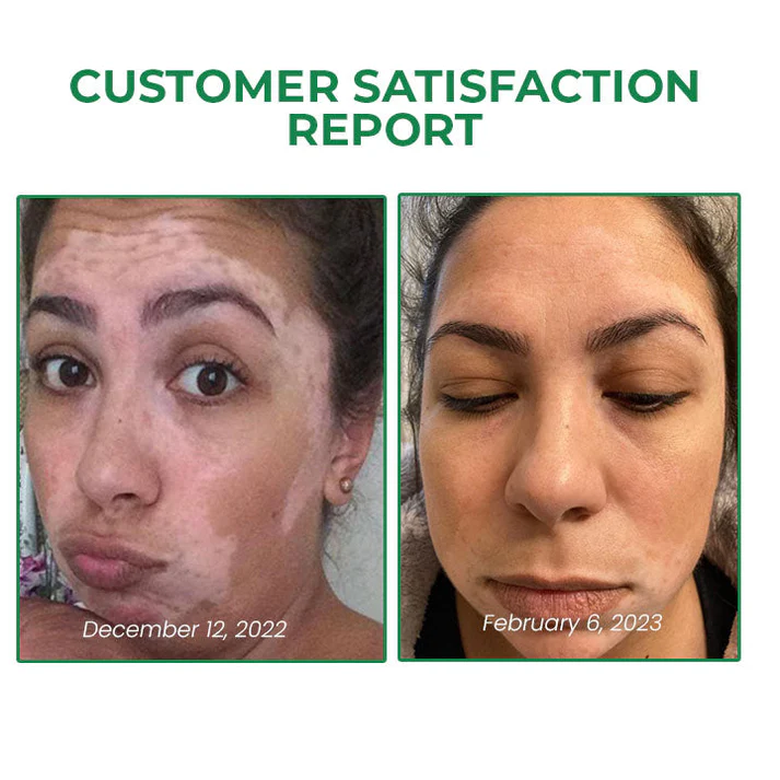 Lovilds™ VitiligoFix Revitalize Elixir - Image 8