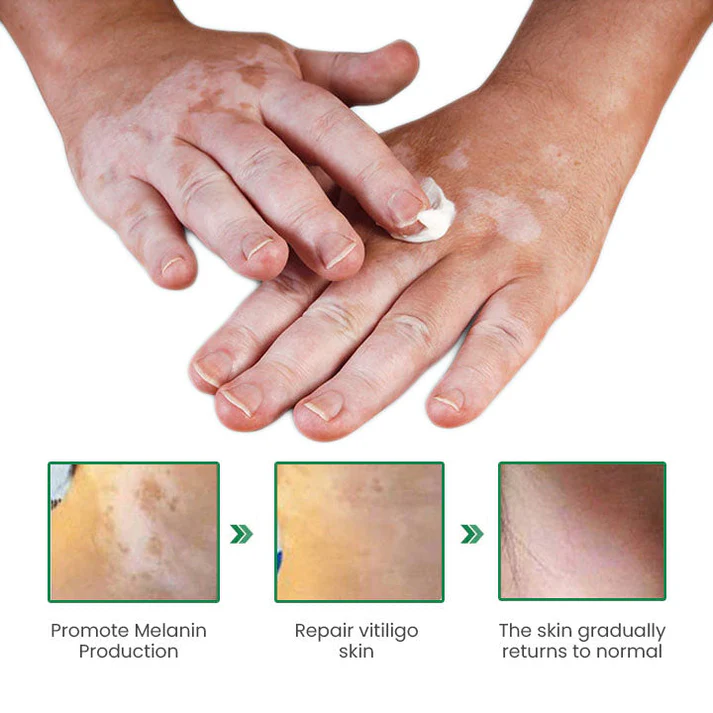 Lovilds™ VitiligoFix Revitalize Elixir - Image 7