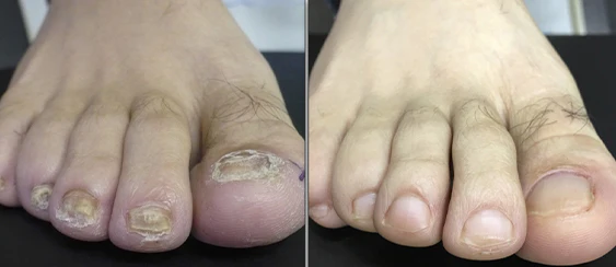 Biancat™ FungiFix Nagelpilz-Pflegefluid - Image 6