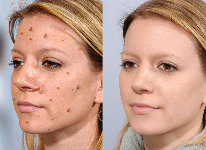 Biancat™ Bienenstich-Warzenpflegespray - Image 8