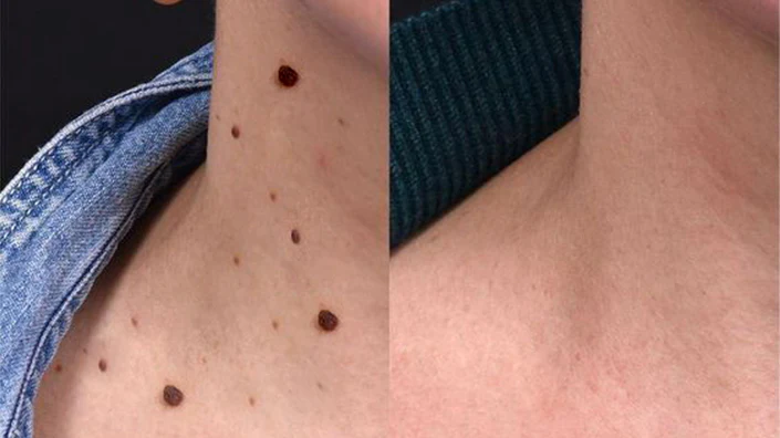 Biancat™ Bienenstich-Warzenpflegespray - Image 7