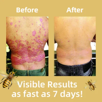 LOVILDS® Bee Venom Psoriasis Treatment Cream - Image 3