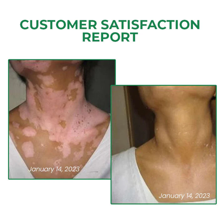Lovilds™ VitiligoFix Revitalize Elixir - Image 3