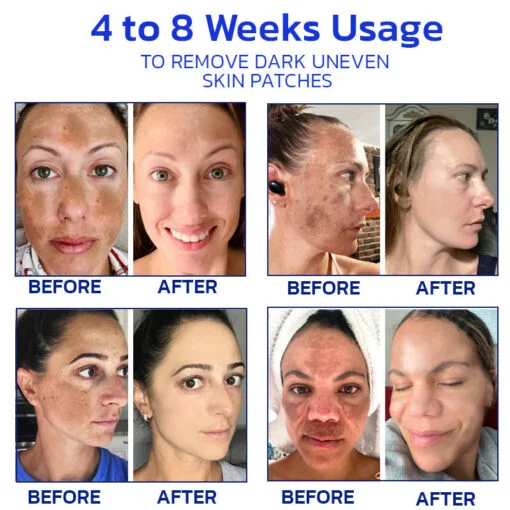 Furzero™ NonSpot Bee Venom Pigment Correction Cream - Image 7