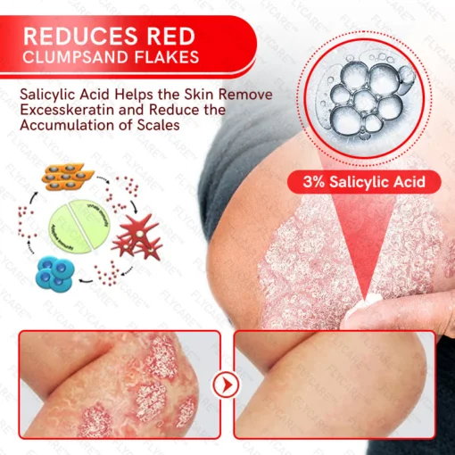 FLYCARE™ Bee Venom Multi-Symptom Psoriasis Cream - Image 4