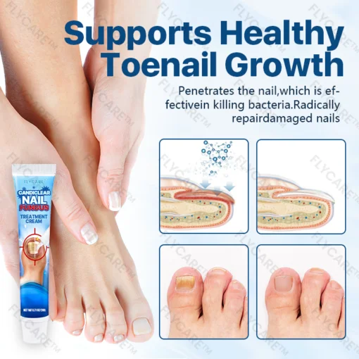 FLYCARE™ Candiclear Nail Fungus Treatment Cream - Image 3