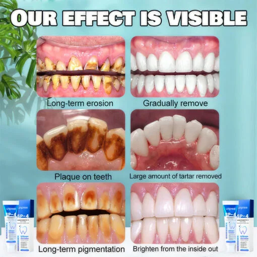 Unpree™ SP-4 Probiotic Whitening Toothpaste - Image 3