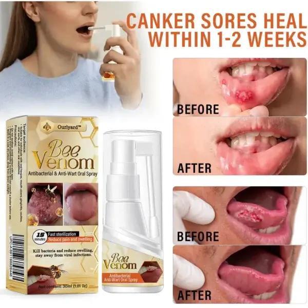 Ourlyard™ Bee Venom Antibacterial & Anti-Wart Oral Spray - Image 5