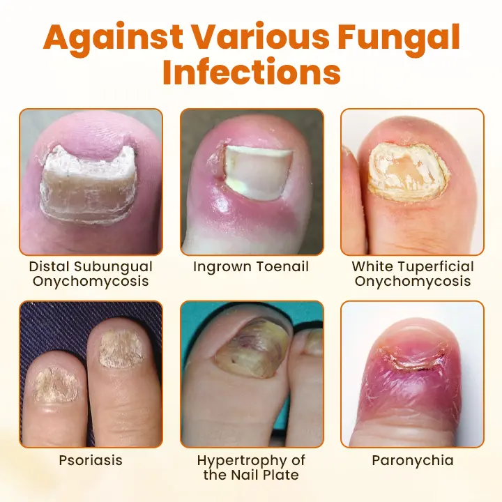 Timilk® FungiBee Advanced Nail Repair Spray - Image 8