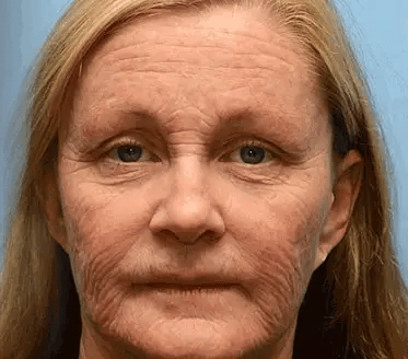 Mayo Clinic Official: coastglee®Bee Toxin Skin Treatment Cream Anti-aging, Hydrating, Skin Repair, Even Tone, Acne and Dark Spot Treatment, Wart and Mole Removal, Psoriasis Relief - Image 9