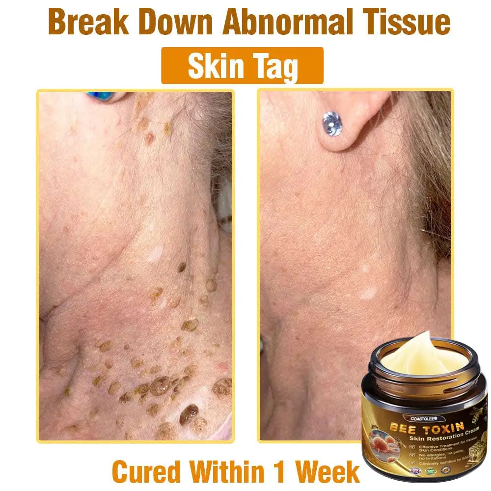 Mayo Clinic Official: coastglee®Bee Toxin Skin Treatment Cream Anti-aging, Hydrating, Skin Repair, Even Tone, Acne and Dark Spot Treatment, Wart and Mole Removal, Psoriasis Relief - Image 8