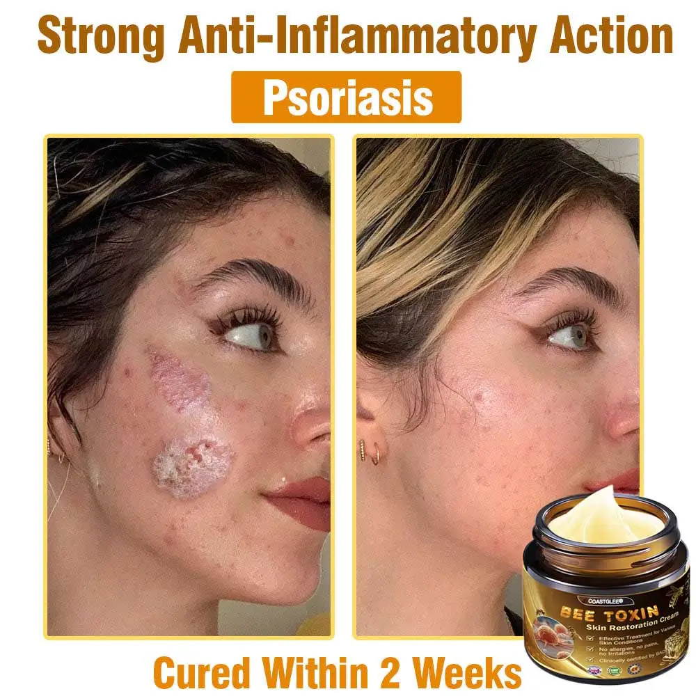 Mayo Clinic Official: coastglee®Bee Toxin Skin Treatment Cream Anti-aging, Hydrating, Skin Repair, Even Tone, Acne and Dark Spot Treatment, Wart and Mole Removal, Psoriasis Relief - Image 7