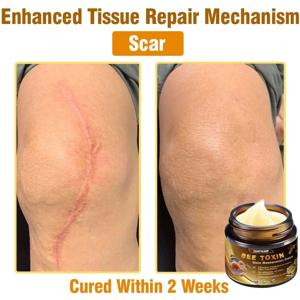 Mayo Clinic Official: coastglee®Bee Toxin Skin Treatment Cream Anti-aging, Hydrating, Skin Repair, Even Tone, Acne and Dark Spot Treatment, Wart and Mole Removal, Psoriasis Relief - Image 6