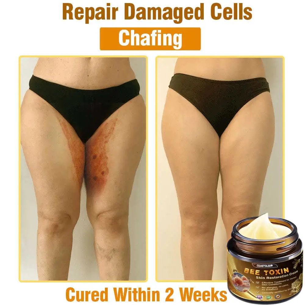 Mayo Clinic Official: coastglee®Bee Toxin Skin Treatment Cream Anti-aging, Hydrating, Skin Repair, Even Tone, Acne and Dark Spot Treatment, Wart and Mole Removal, Psoriasis Relief - Image 4