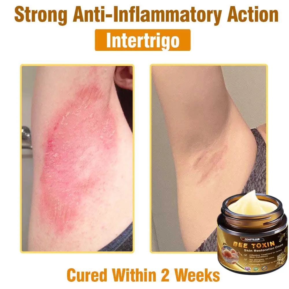 Mayo Clinic Official: coastglee®Bee Toxin Skin Treatment Cream Anti-aging, Hydrating, Skin Repair, Even Tone, Acne and Dark Spot Treatment, Wart and Mole Removal, Psoriasis Relief - Image 5