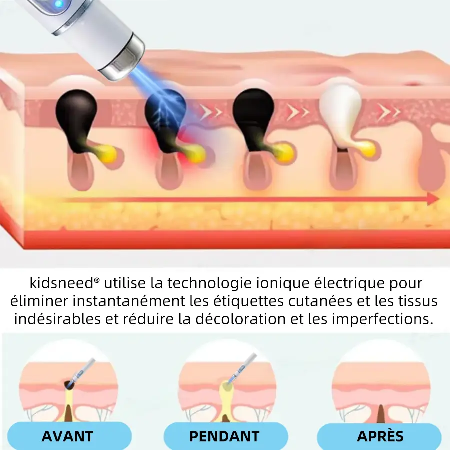 Recommandé par l’ANSM👩⚕️𝐤𝐢𝐝𝐬𝐧𝐞𝐞𝐝® 𝐆𝐫𝐚𝐢𝐧𝐬 𝐝𝐞 𝐛𝐞𝐚𝐮𝐭é 𝐞𝐭 𝐯𝐞𝐫𝐫𝐮𝐞𝐬 𝐧𝐨𝐧 𝐢𝐧𝐯𝐚𝐬𝐢𝐟𝐬 𝐒𝐭𝐲𝐥𝐨 𝐥𝐚𝐬𝐞𝐫 𝐝'é𝐥𝐢𝐦𝐢𝐧𝐚𝐭𝐢𝐨𝐧(Élimination rapide et indolore des verrues, grains de beauté, taches de vieillesse et excroissances cutanées — totalement sans effets secondaires)🎉 - Image 10