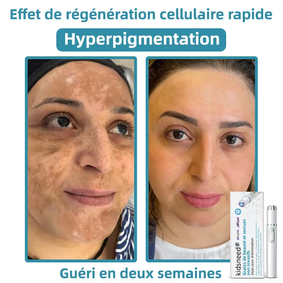 Recommandé par l’ANSM👩⚕️𝐤𝐢𝐝𝐬𝐧𝐞𝐞𝐝® 𝐆𝐫𝐚𝐢𝐧𝐬 𝐝𝐞 𝐛𝐞𝐚𝐮𝐭é 𝐞𝐭 𝐯𝐞𝐫𝐫𝐮𝐞𝐬 𝐧𝐨𝐧 𝐢𝐧𝐯𝐚𝐬𝐢𝐟𝐬 𝐒𝐭𝐲𝐥𝐨 𝐥𝐚𝐬𝐞𝐫 𝐝'é𝐥𝐢𝐦𝐢𝐧𝐚𝐭𝐢𝐨𝐧(Élimination rapide et indolore des verrues, grains de beauté, taches de vieillesse et excroissances cutanées — totalement sans effets secondaires)🎉 - Image 12