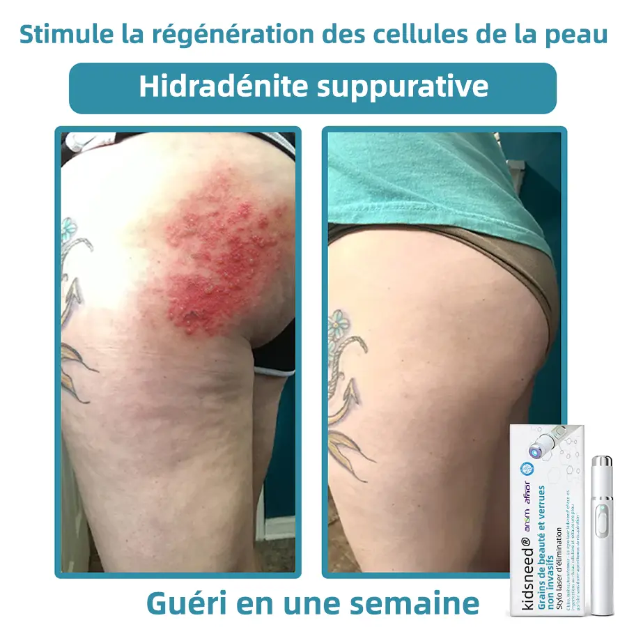Recommandé par l’ANSM👩⚕️𝐤𝐢𝐝𝐬𝐧𝐞𝐞𝐝® 𝐆𝐫𝐚𝐢𝐧𝐬 𝐝𝐞 𝐛𝐞𝐚𝐮𝐭é 𝐞𝐭 𝐯𝐞𝐫𝐫𝐮𝐞𝐬 𝐧𝐨𝐧 𝐢𝐧𝐯𝐚𝐬𝐢𝐟𝐬 𝐒𝐭𝐲𝐥𝐨 𝐥𝐚𝐬𝐞𝐫 𝐝'é𝐥𝐢𝐦𝐢𝐧𝐚𝐭𝐢𝐨𝐧(Élimination rapide et indolore des verrues, grains de beauté, taches de vieillesse et excroissances cutanées — totalement sans effets secondaires)🎉 - Image 13