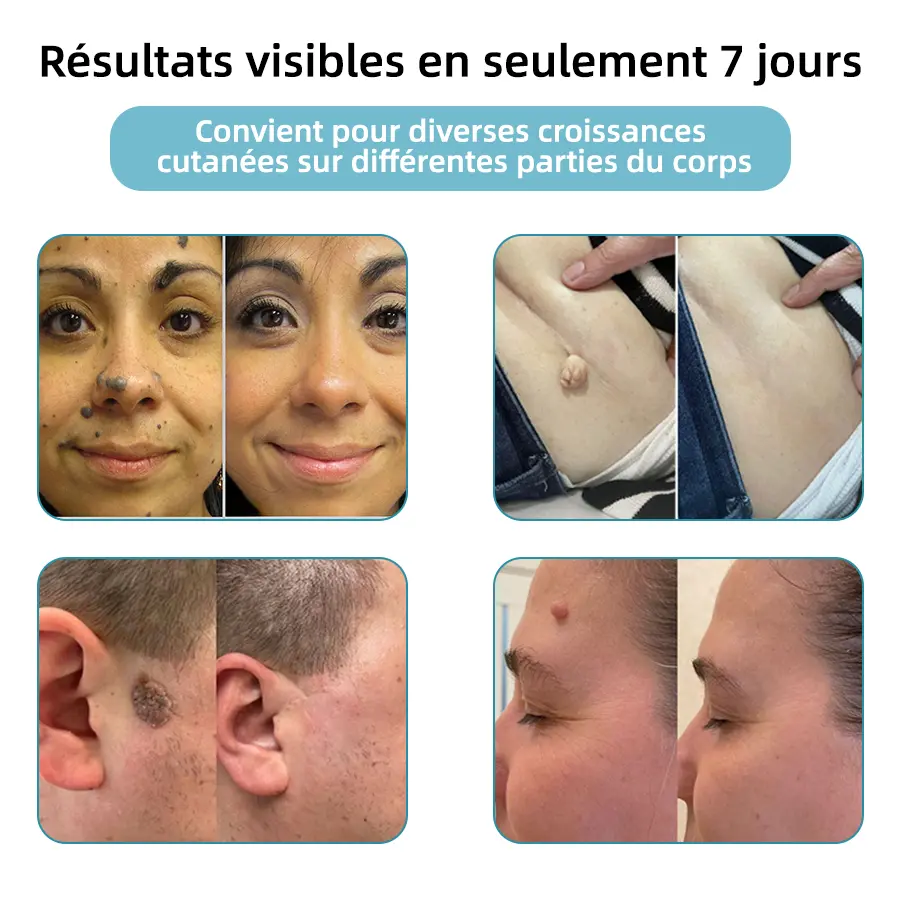 Recommandé par l’ANSM👩⚕️𝐤𝐢𝐝𝐬𝐧𝐞𝐞𝐝® 𝐆𝐫𝐚𝐢𝐧𝐬 𝐝𝐞 𝐛𝐞𝐚𝐮𝐭é 𝐞𝐭 𝐯𝐞𝐫𝐫𝐮𝐞𝐬 𝐧𝐨𝐧 𝐢𝐧𝐯𝐚𝐬𝐢𝐟𝐬 𝐒𝐭𝐲𝐥𝐨 𝐥𝐚𝐬𝐞𝐫 𝐝'é𝐥𝐢𝐦𝐢𝐧𝐚𝐭𝐢𝐨𝐧(Élimination rapide et indolore des verrues, grains de beauté, taches de vieillesse et excroissances cutanées — totalement sans effets secondaires)🎉 - Image 3