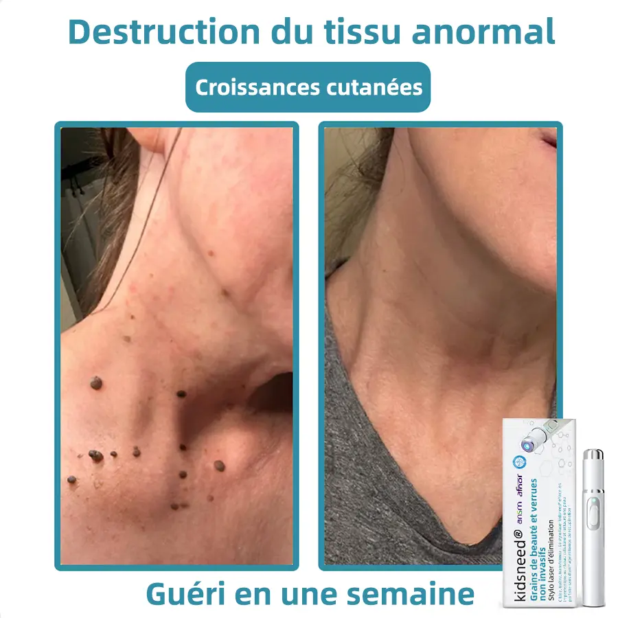 Recommandé par l’ANSM👩⚕️𝐤𝐢𝐝𝐬𝐧𝐞𝐞𝐝® 𝐆𝐫𝐚𝐢𝐧𝐬 𝐝𝐞 𝐛𝐞𝐚𝐮𝐭é 𝐞𝐭 𝐯𝐞𝐫𝐫𝐮𝐞𝐬 𝐧𝐨𝐧 𝐢𝐧𝐯𝐚𝐬𝐢𝐟𝐬 𝐒𝐭𝐲𝐥𝐨 𝐥𝐚𝐬𝐞𝐫 𝐝'é𝐥𝐢𝐦𝐢𝐧𝐚𝐭𝐢𝐨𝐧(Élimination rapide et indolore des verrues, grains de beauté, taches de vieillesse et excroissances cutanées — totalement sans effets secondaires)🎉 - Image 5